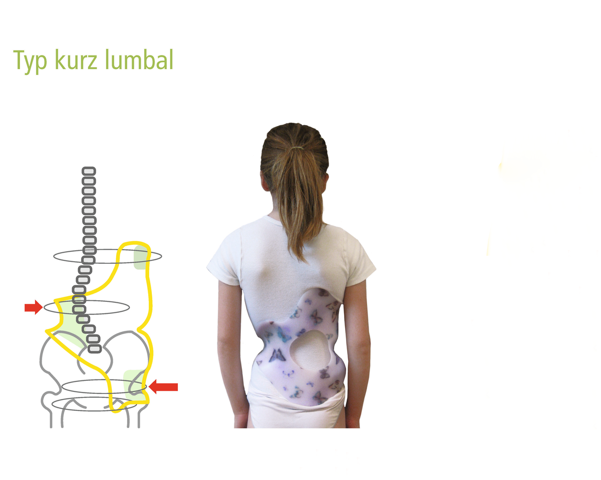 Skoliose Korsett Bis Zu Welchem Alter www.pohlig.net